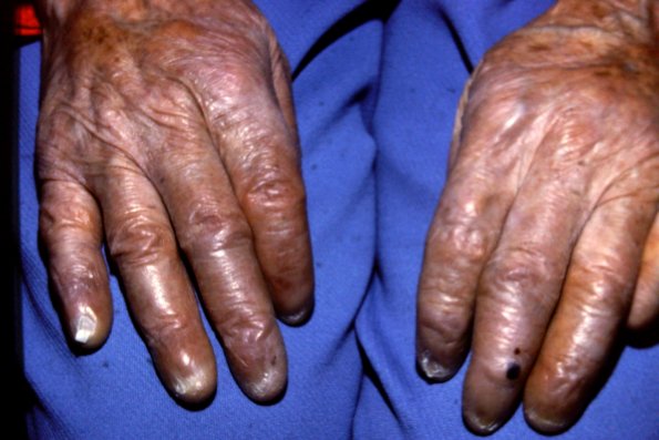 Lepromatous Leprosy (5)