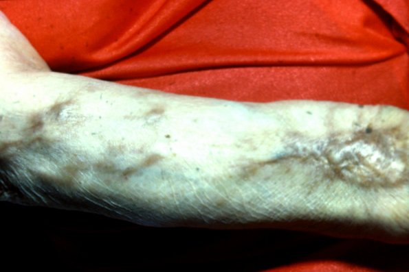 Lepromurous Leprosy