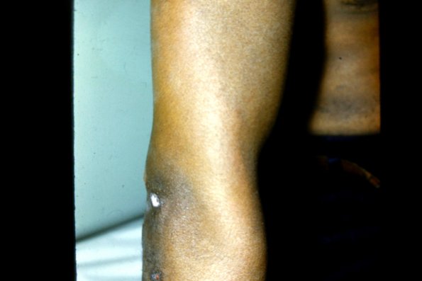 Leprosy (5)