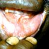 Mouth Lesions (2)