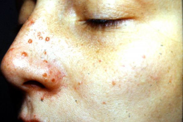 Skin Lesions (2)