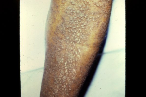 Lichen Amyloidosus Localized Papular