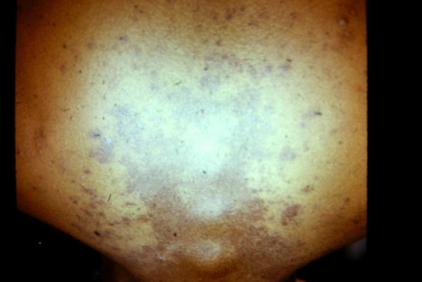 Lichen Planus (39)