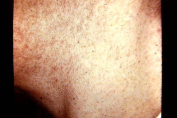 Lichen Planus (40)