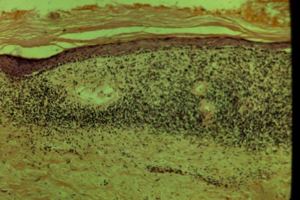 Lichen Planus (46)