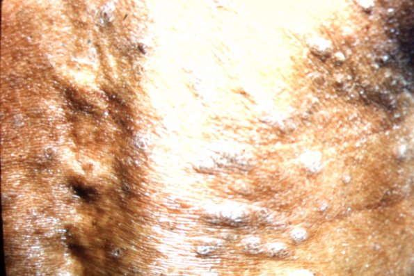 Lichen Planus (49)