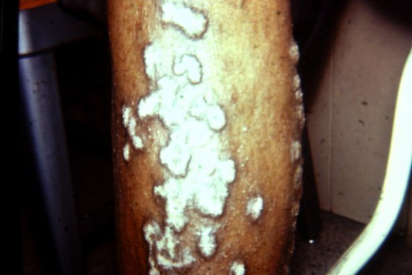 Lichen Planus (58)