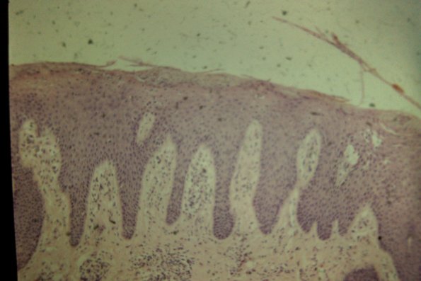 Lichen Simplex Chronicus (20)