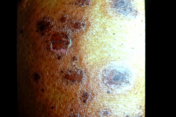 Pityriasis Lichenoides