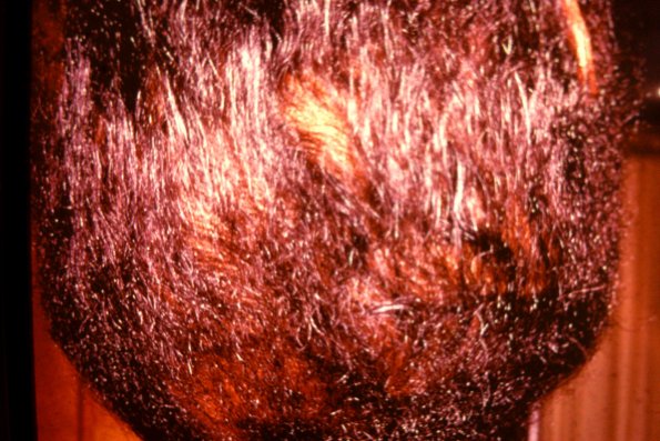 Lipedematous Alopecia