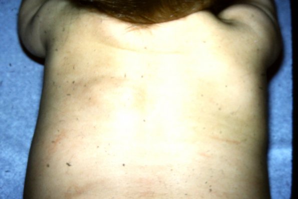 Lipoma (2)