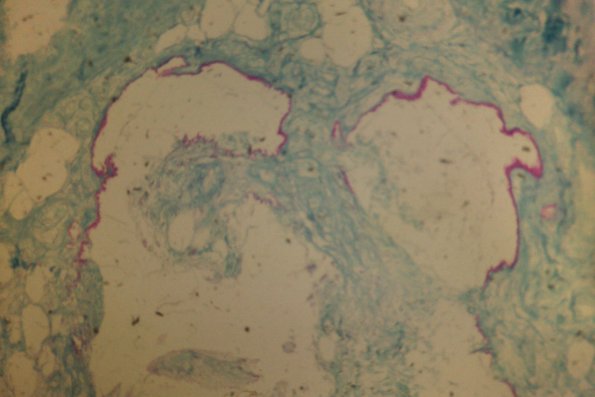 Lipomembranous Panniculitis (3)