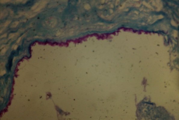 Lipomembranous Panniculitis (4)