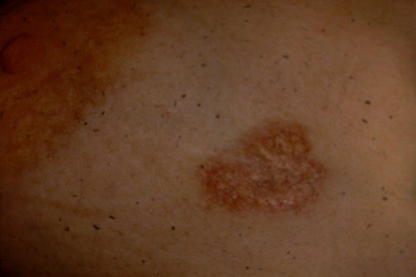 Necrobiosis Lipoidica (2)