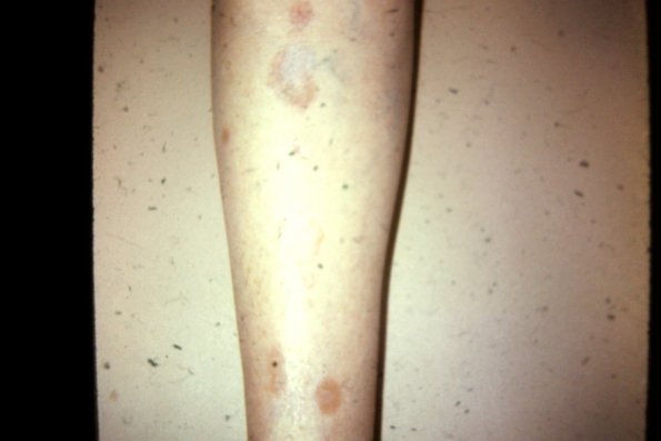 Necrobiosis Lipoidica (3)