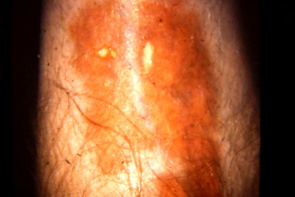 Necrobiosis Lipoidica (6)