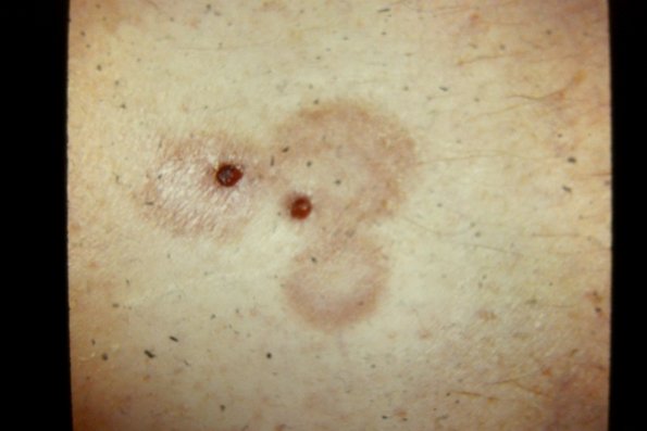 Necrobiosis Lipoidica (7)