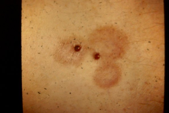 Necrobiosis Lipoidica (8)