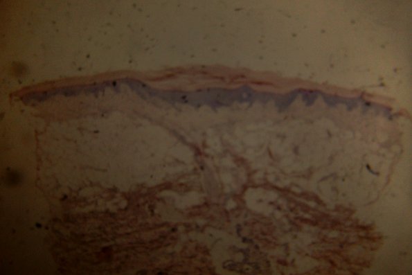 Nevus Lipomatosus Superficialis
