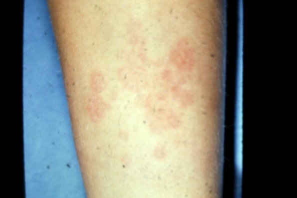 Nicrobiosis Lipodica (2)