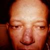 Discoid Lupus Erythematous