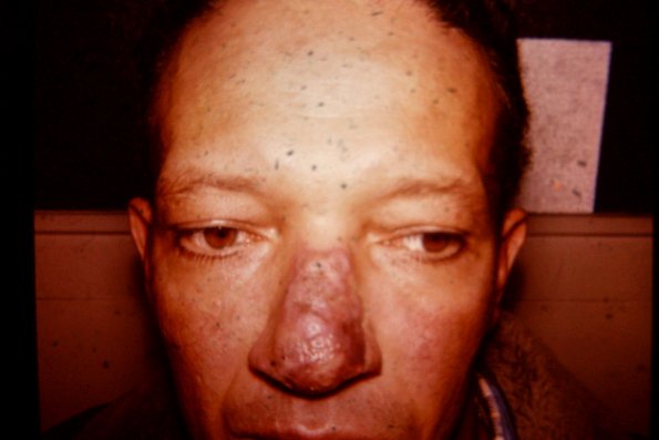 Discoid Lupus Erythematous