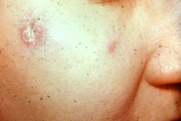 Lupus Erythematous (3)