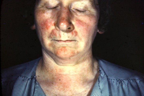 Lupus Erythematous