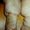 Lymphedema (2)