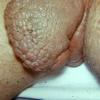 Lymphedema