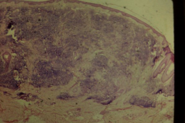 Lymphocytoma (4)