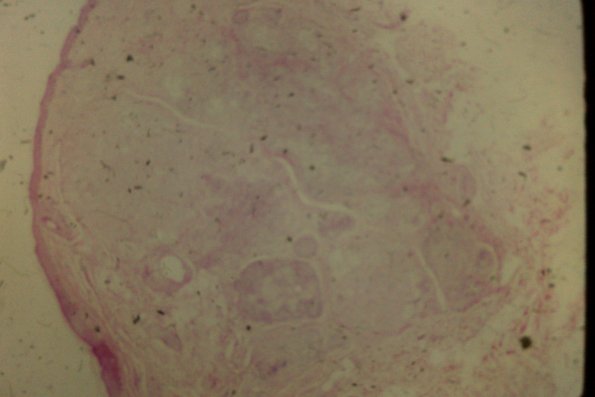 Cutaneous Lymphodonoma (11)