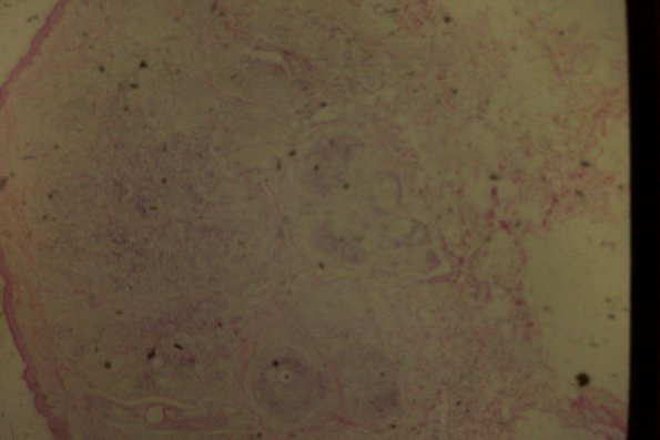 Cutaneous Lymphodonoma (15)