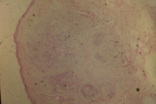 Cutaneous Lymphodonoma (17)