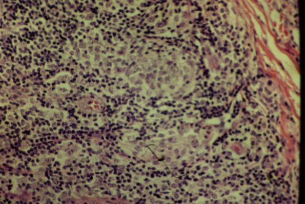 Cutaneous Lymphodonoma (23)