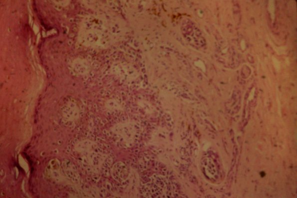 Cutaneous Lymphodonoma (25)