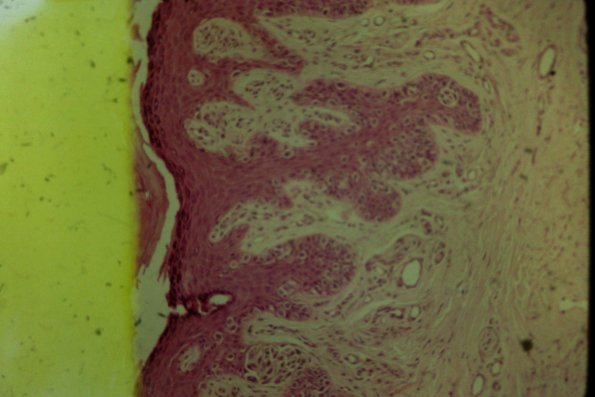 Cutaneous Lymphodonoma (27)