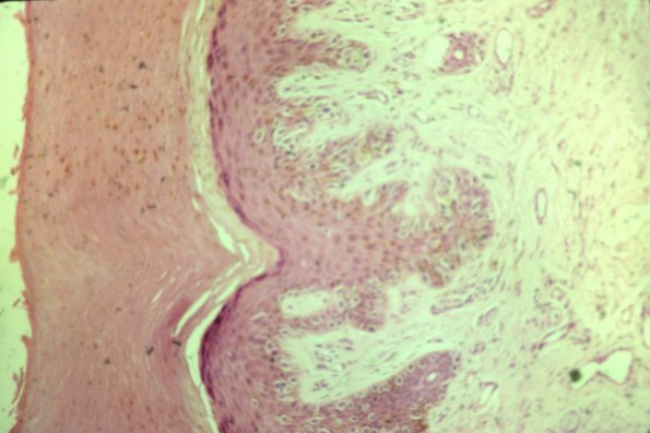 Cutaneous Lymphodonoma (28)