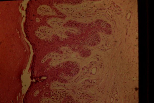 Cutaneous Lymphodonoma (29)