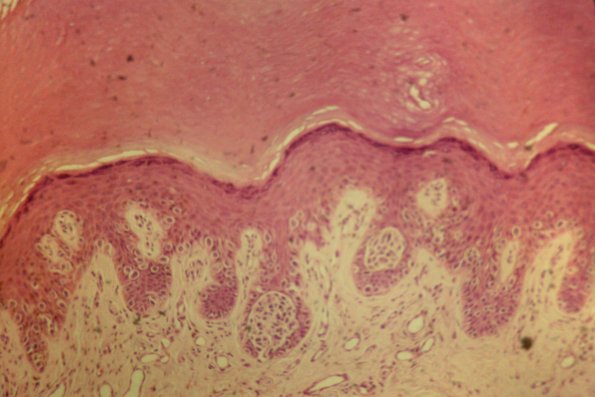 Cutaneous Lymphodonoma (30)