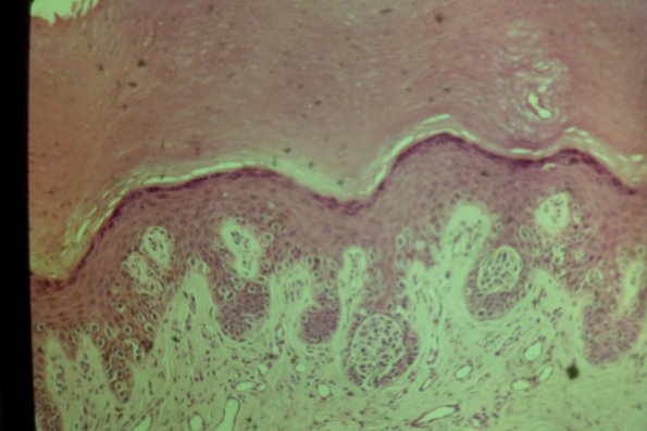 Cutaneous Lymphodonoma (31)