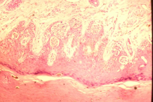 Cutaneous Lymphodonoma (34)