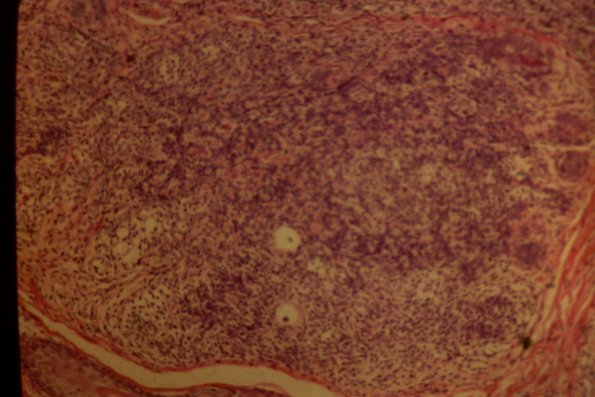 Cutaneous Lymphodonoma (37)