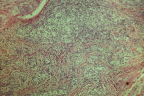 Cutaneous Lymphodonoma (40)