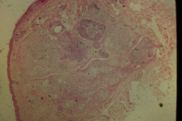 Cutaneous Lymphodonoma (43)