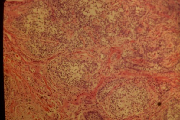 Cutaneous Lymphodonoma (44)