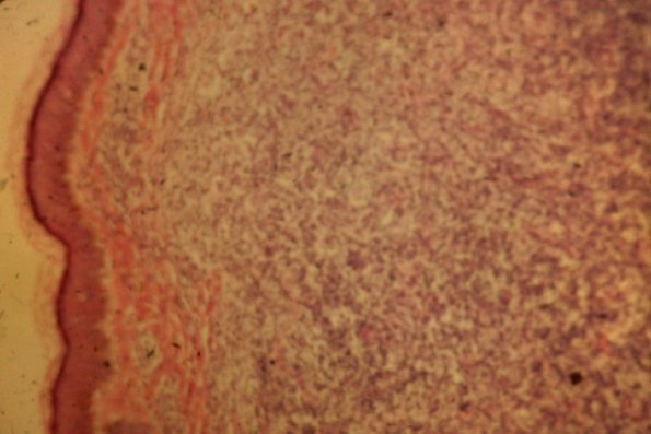 Cutaneous Lymphodonoma (45)