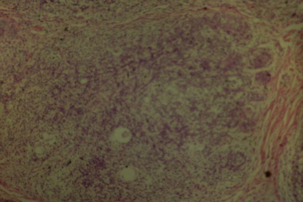 Cutaneous Lymphodonoma (6)