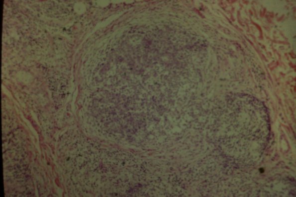 Cutaneous Lymphodonoma (7)