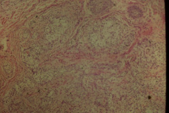 Cutaneous Lymphodonoma (8)